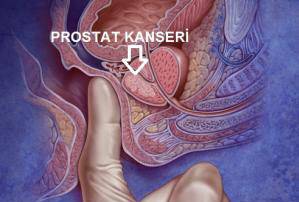 prostat-kanseri.jpg