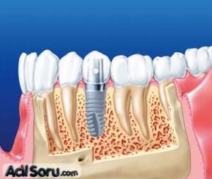 implant nedir